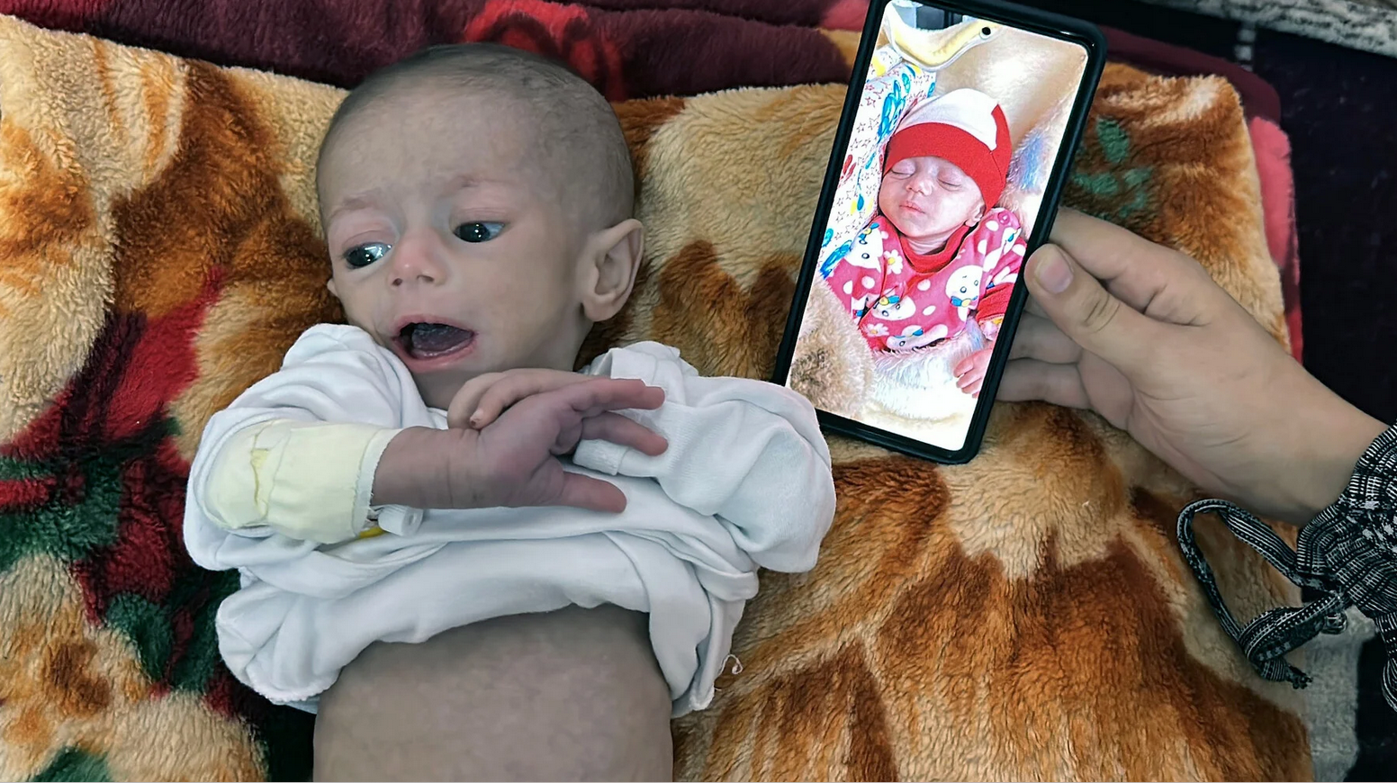 La Palestine en photos. 30 avril. La petite Siwar Ashour, cinq mois, reçoit des soins médicaux en raison de sa malnutrition sévère au Complexe médical Nasser à Khan Younis, dans le sud de la bande de Gaza