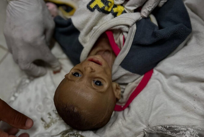 25 juillet 2025 - Zainab Abu Haleeb, une enfant de 6 mois, est décédée à l'hôpital Nasser, des suites de malnutrition due à une pénurie de lait et à l'indisponibilité des traitements nécessaires pour les enfants dans la bande de Gaza - Photo : Doaa Albaz / Activestills