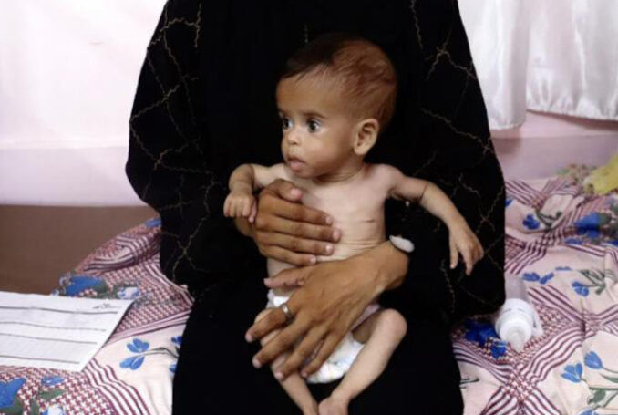 Un nourisson affecté par la malnutrition. Photo : Activestills.